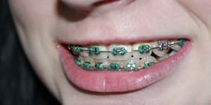 Colocação de Aparelho para corrigir os dentes na Clínica Costa Odontologia em Ipatinga